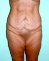 Tummy Tuck