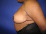 Breast Reduction