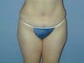 Mommy Make Over Tummy Tuck