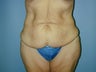 Mommy Make Over Tummy Tuck