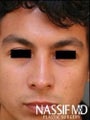 Hispanic Male Rhinoplasty 