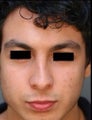 Hispanic Male Rhinoplasty 