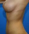 Liposuction