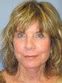 LiteLift, SMAS Facelift, Mini Lift