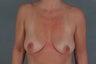 Breast Augmentation