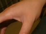 Tattoo Removal