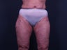 Liposuction Inner & Outer Thighs