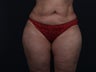 Liposuction Inner & Outer Thighs