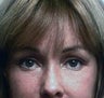 Forehead Brow Lift