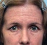 Forehead Brow Lift