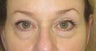 Lower lid bags treated with fillers to tear trough area and midface 