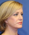 Middle age woman treated with Perma-Lift Facelift and necklift.