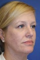 Middle age woman treated with Perma-Lift Facelift and necklift.