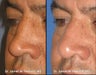 Rhinoplasty / Nasal Surgery