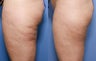 37 year old with cellulite