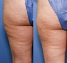 37 year old with cellulite