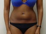 Liposuction