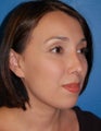 Rhinoplasty