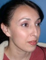 Rhinoplasty