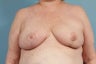 Breast Reconstruction Patient