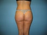 Brazilian buttock lft