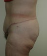 Body Lift