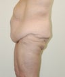 Body Lift
