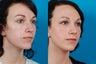 Rhinoplasty