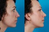 Rhinoplasty