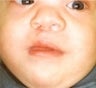 Infant who underwent surgery for a cleft lip and palate 