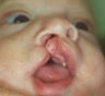 Infant who underwent surgery for a cleft lip and palate 