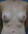 Breast Implants