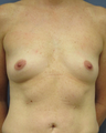 Breast Implants