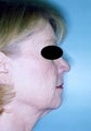55 year old female patient 
