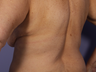 CoolSculpting by Zeltiq to Bra Rolls/Back Fat