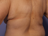 CoolSculpting by Zeltiq to Bra Rolls/Back Fat