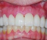 Dental Crowns