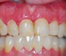 Dental Crowns