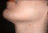 Laser hair removal in Middle-Easterner