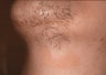 Laser hair removal in Middle-Easterner