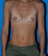 Breast Augmentation