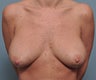 46 Year Old Female Treated For Bottoming Out Of Old Breast Implants