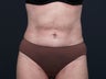 Liposuction Abdomen, Flanks, Inner & Outer Thighs