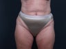 Liposuction Abdomen, Flanks, Inner & Outer Thighs