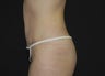 Abdominoplasty