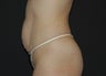 Abdominoplasty