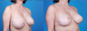 Revision Breast Surgery