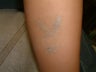 Tattoo Removal