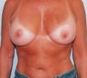 46-Year-Old Female Breast Augmentation