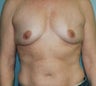 46-Year-Old Female Breast Augmentation
